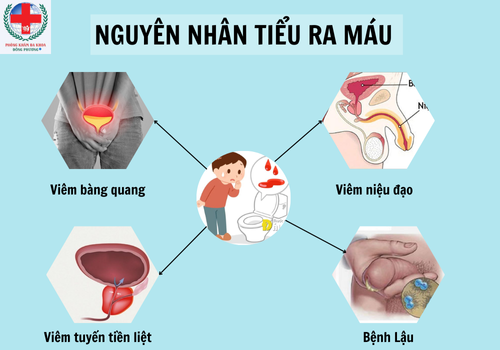 TIỂU RA MÁU.png